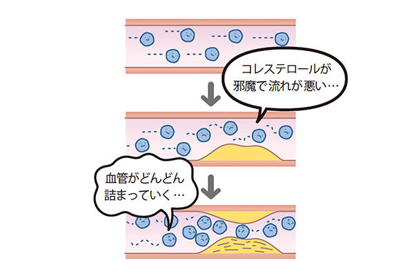 脂が血管にたまってどろどろの血液に<br>血管にコレステロールがたまると、血管の壁に脂肪分が沈着していく。その結果、血管が狭くなったり、詰まったりして、心臓に負担がかかるほか、血管も壊れやすくなってしまい、また各臓器や組織に栄養がいきわたらなくなる。