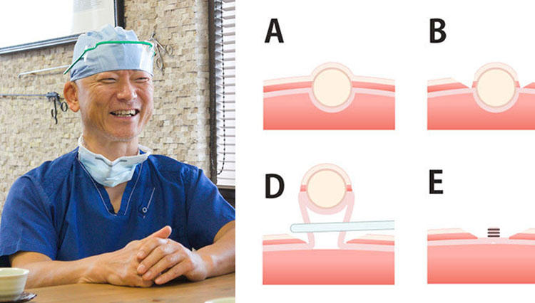 内視鏡外科手術のパイオニアに聞いた、負担最小の最新「胃がん」手術法とは？