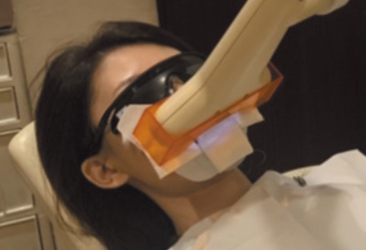 ホワイトニング施術の様子